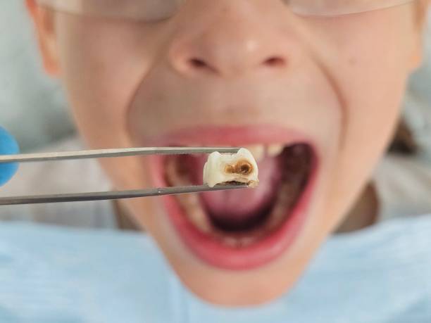 Best Emergency Tooth Extraction in Bigfoot, TX